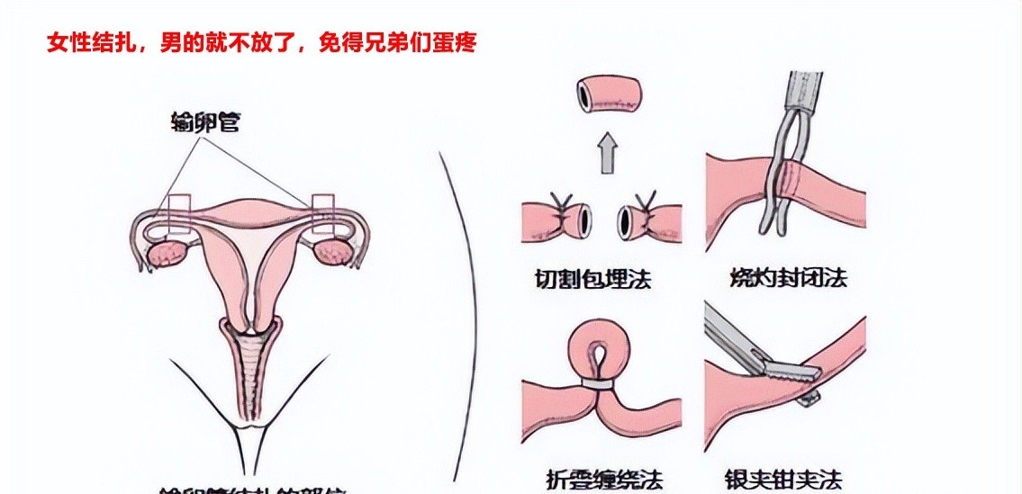 女性结扎方法.jpg